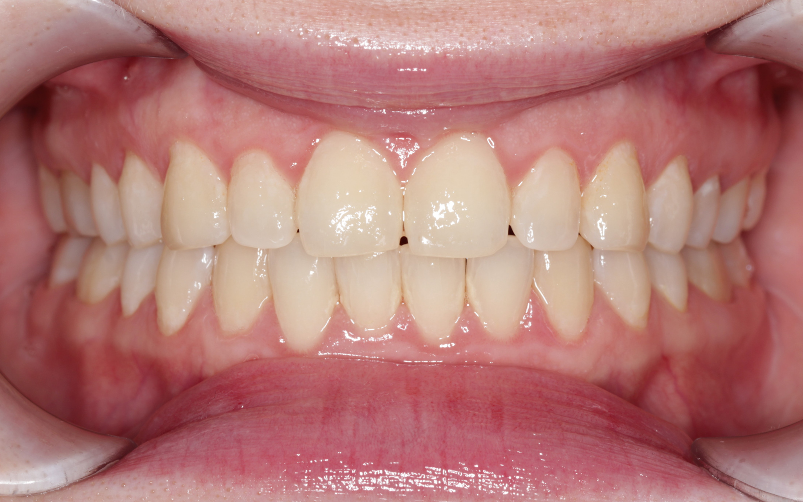 Снятие твердого зубного налета и полировка эмали — Исходное состояние До