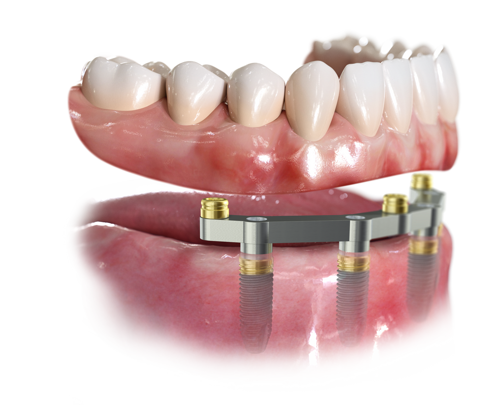 Протезирование ALL-ON-4 